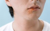 cold sores alzheimers