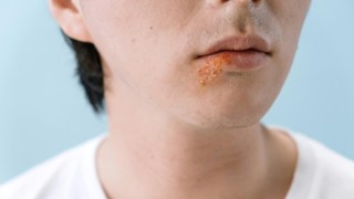cold sores alzheimers