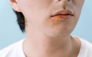 cold sores alzheimers