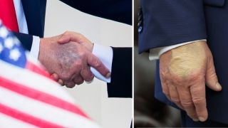 trump bruise